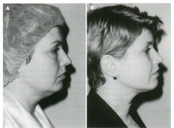 Dermatologic Surgery. May 2002. Number 5. Volume 28