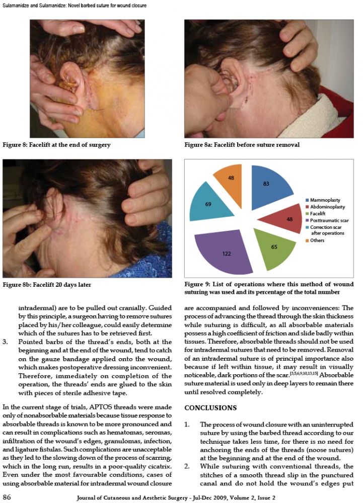 Journal of Cutaneous and Aesthetic Surgery - Jul-Dec 2009, Volume 2, Issue 2