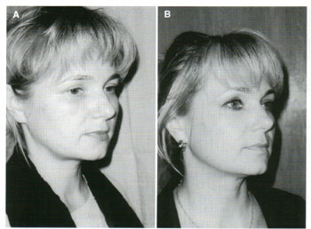 Dermatologic Surgery. May 2002. Number 5. Volume 28