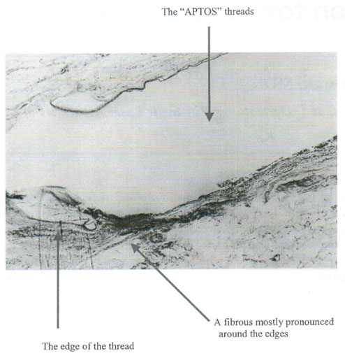 Dermatologic Surgery. May 2002. Number 5. Volume 28