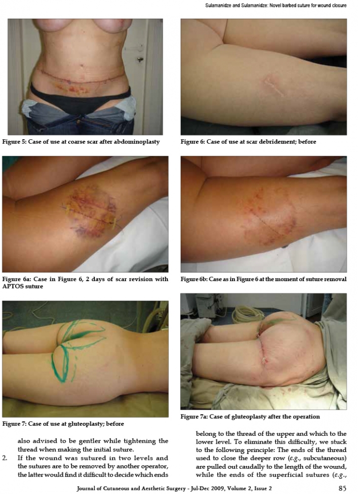 Journal of Cutaneous and Aesthetic Surgery - Jul-Dec 2009, Volume 2, Issue 2