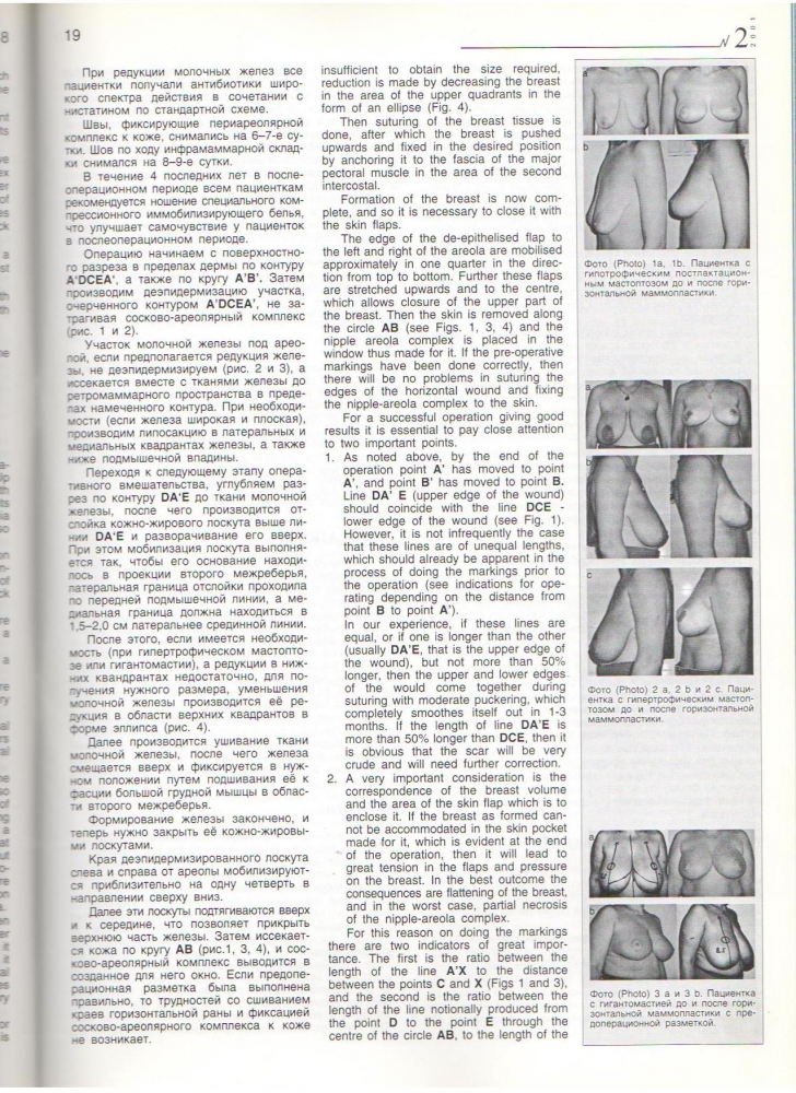HERALD №2/2001 Горизонт. Маммапластика