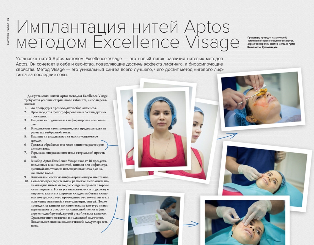 Имплантация нитей Aptos методом Excellence Visage