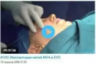 Лифтинг лица